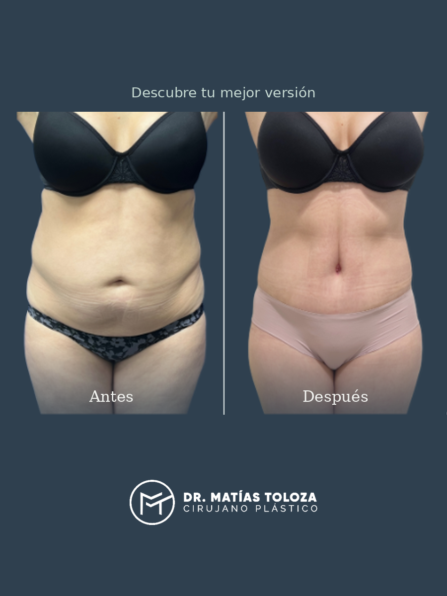 Resultado de abdominoplastia, vista frontal