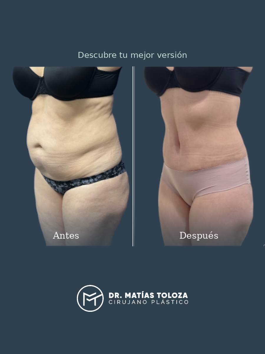 Resultado de abdominoplastia, vista oblicua