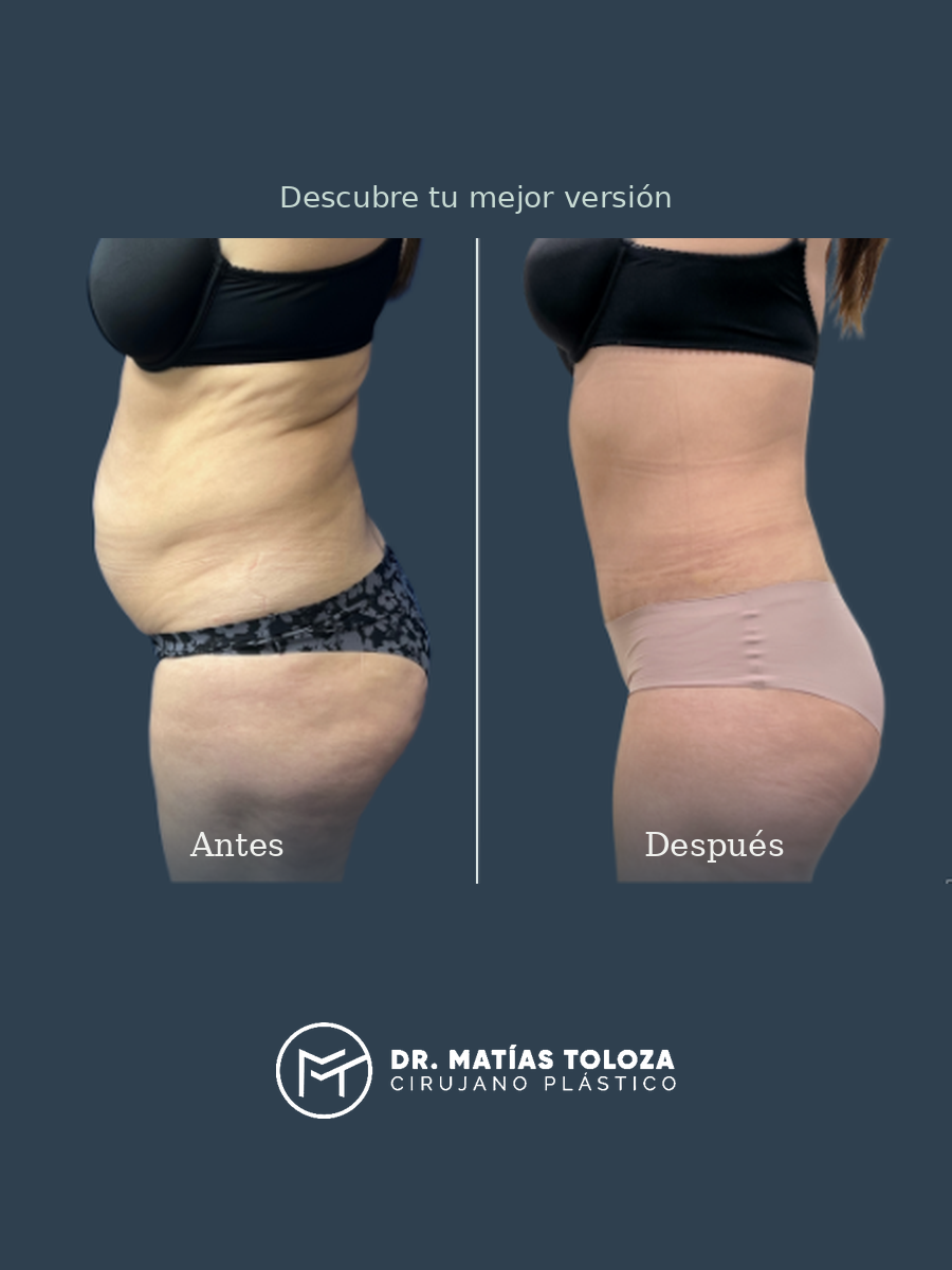 Resultado de abdominoplastia, vista lateral