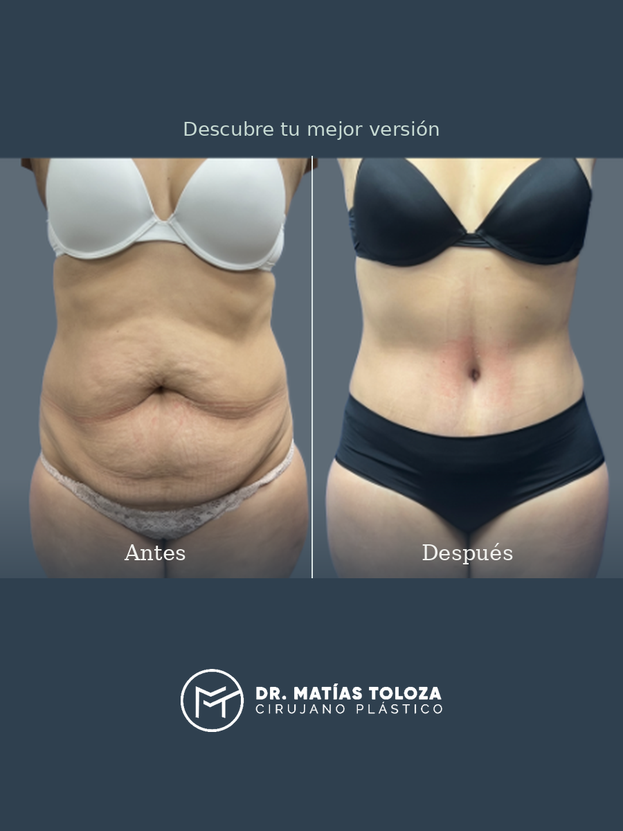 Resultado de lipoabdominoplastia, vista frontal