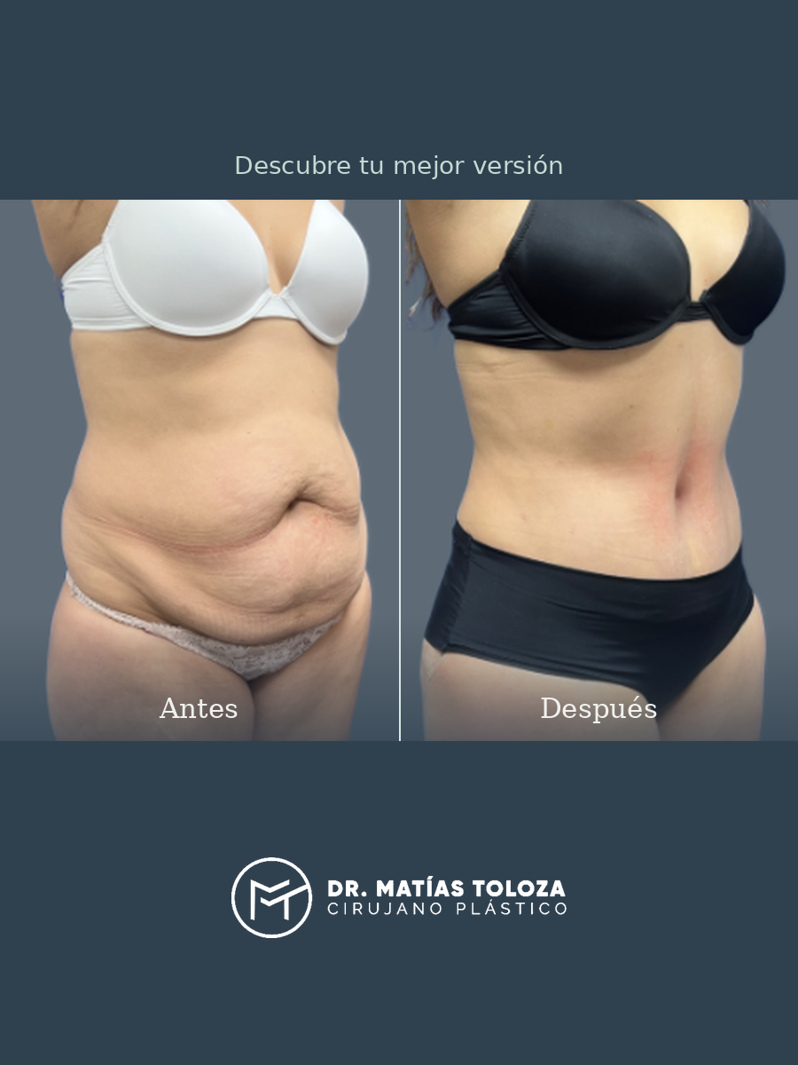Resultado de lipoabdominoplastia, vista oblicua