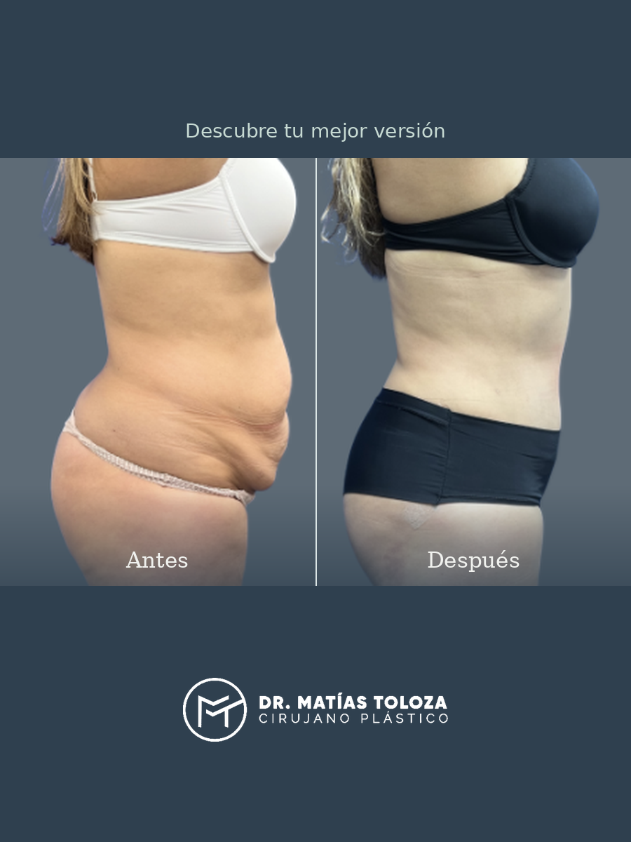 Resultado de lipoabdominoplastia, vista lateral